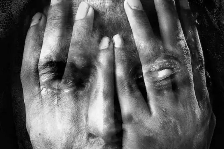 Siblings Throw Acid on Woman, Her 3 Kids over Property Dispute in Gujarat