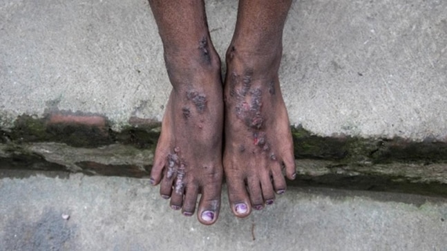 Odisha: Dalit boy suffering from skin disease forced to undergo ‘purification’ by villagers