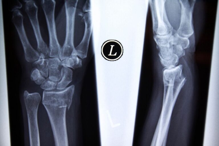 Decoding Long Covid: An Orthopaedic Explains How Prolonged Steroid Use, Bed Rest Can Damage Your Bones