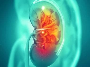 41-yr-old Chennai man walks out of hospital with five kidneys after renal transplant surgery