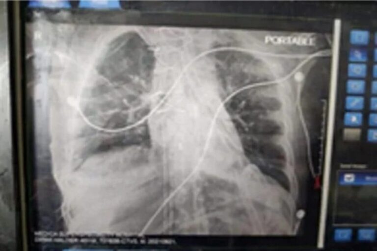 Eastern India’s 1st Successful Lung Transplant Performed at Kolkata Hospital