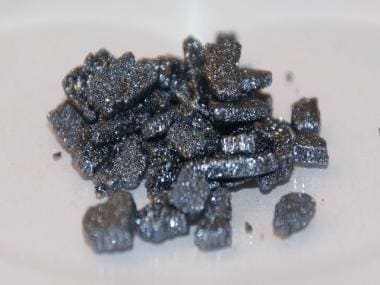 Global Iodine Deficiency Day 2021: Reasons for iodine deficiency in India and ways to counter it