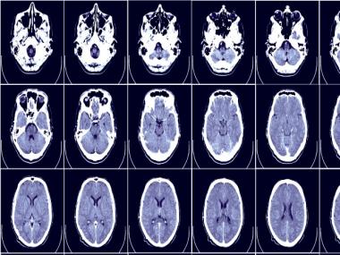 National Epilepsy Day 2021: Symptoms, causes and tips for managing seizures