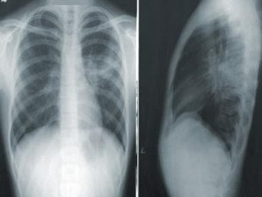 World Pneumonia Day 2021: How to mitigate risk of contracting deadly respiratory infection