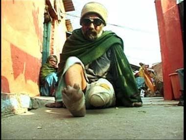 World Leprosy Day 2022: All you need to know about the theme, history and significance 