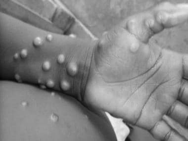 Monkeypox won’t spread like wildfire as we feared for coronavirus, says ICMR’s top virologist