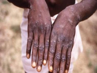 Monkeypox: World already has vaccine, medicines to control the outbreak; details here