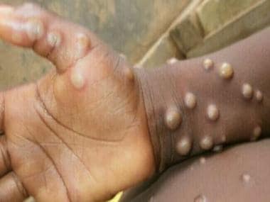 Explained: How the Centre is prepping for monkeypox as it spreads to 23 countries