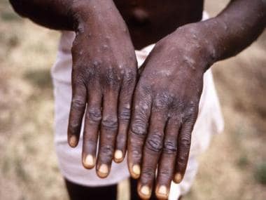 1000 cases of monkeypox in 29 countries: Who is at risk?